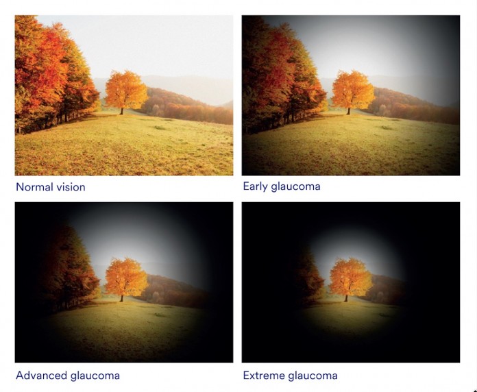 OCP glaucoma vision