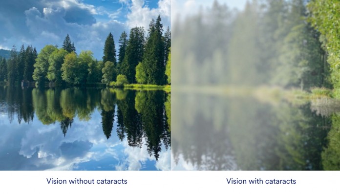 OCP vision with catarats